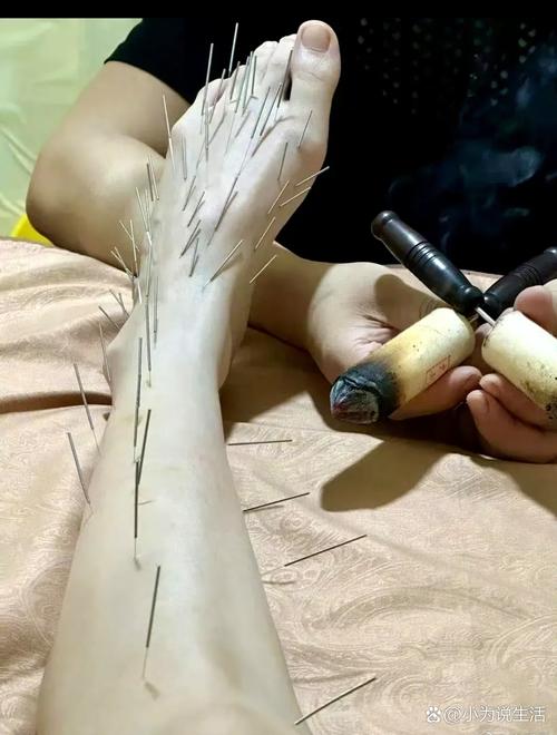 腰间盘突出针灸有效吗