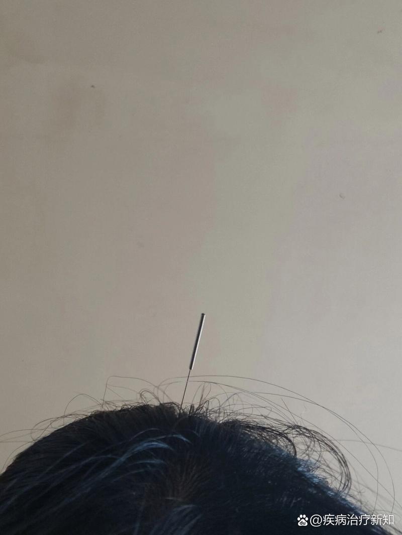 针灸治疗溃疡性结肠炎