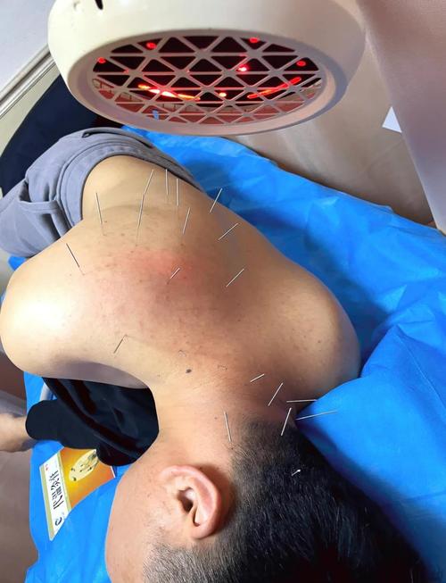 前列腺炎中医针灸治疗