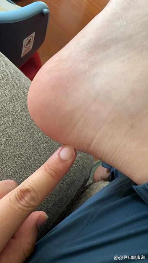 痛风脚后跟有什么症状