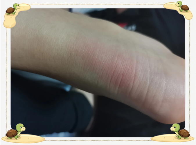 痛风脚后跟有什么症状