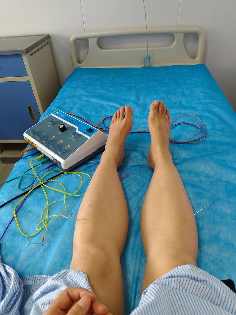 运动神经元病针灸治疗