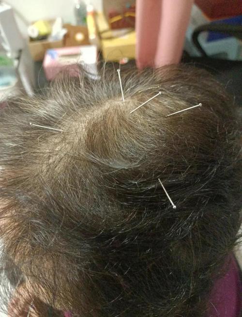 面瘫针灸后遗症怎么办