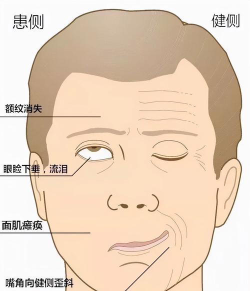 面瘫针灸后遗症怎么办