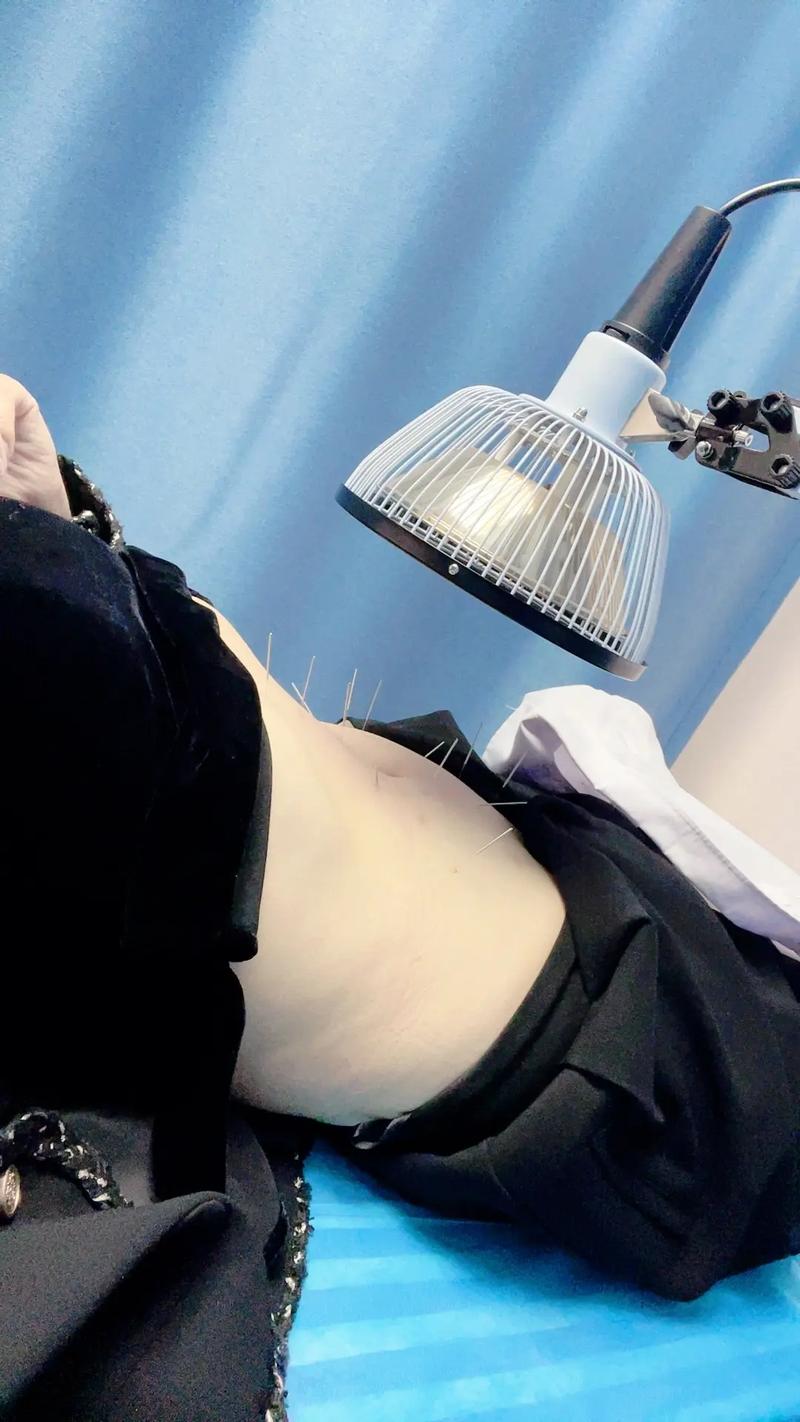 广东省中医院针灸减肥