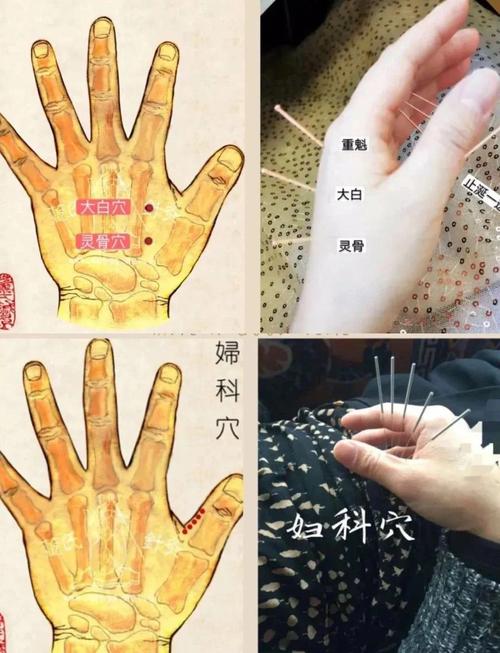 针灸能治疗卵巢囊肿吗