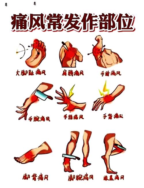 急性痛风为什么那么疼