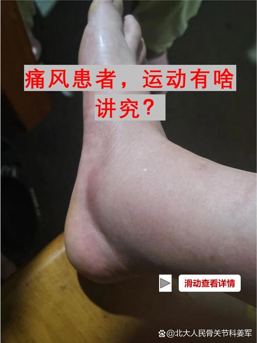 痛风患者能正常活动吗