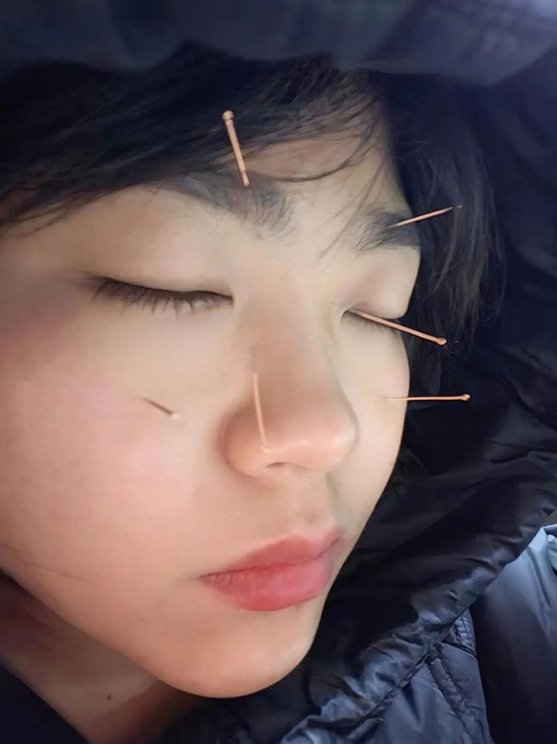 痛性眼肌麻痹针灸治疗