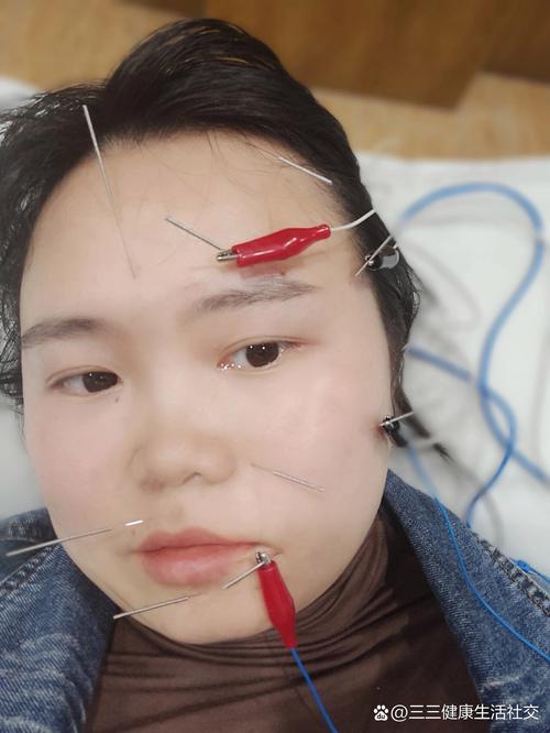 痛性眼肌麻痹针灸治疗