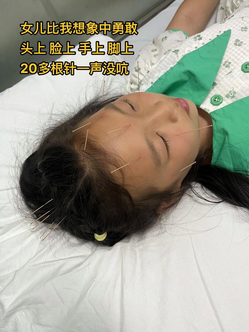 痛性眼肌麻痹针灸治疗