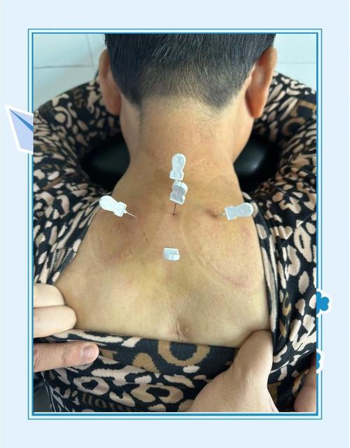 针灸治疗脊髓型颈椎病