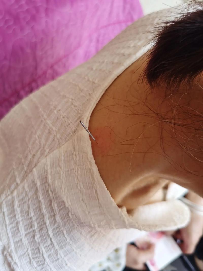 淋巴结肿大针灸能治疗