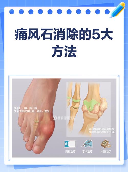 痛风结节能自行消除吗