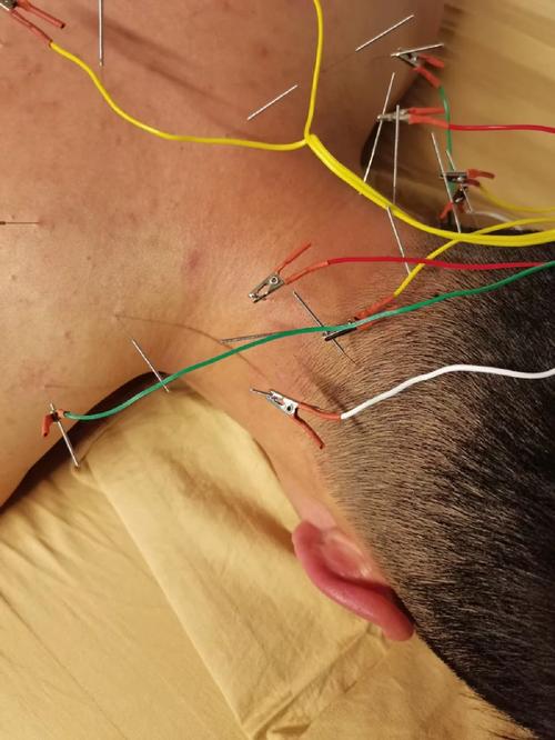 椎动脉型颈椎病 针灸