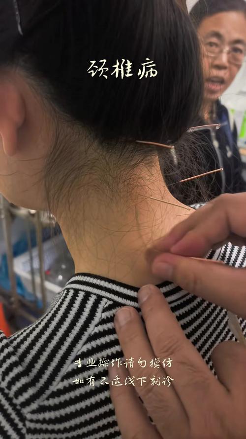 椎动脉型颈椎病 针灸
