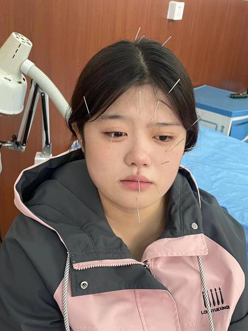 面部神经炎针灸后脸肿