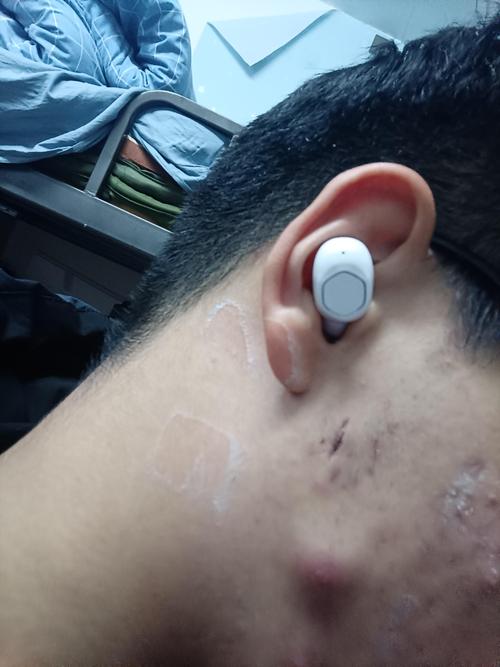 面部神经炎针灸后脸肿