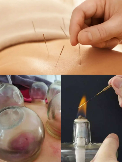 带状疱疹针灸多久能好