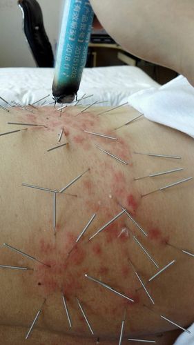 带状疱疹针灸多久能好