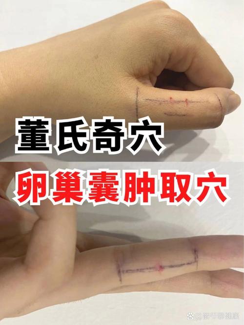 卵巢囊肿能针灸治疗吗