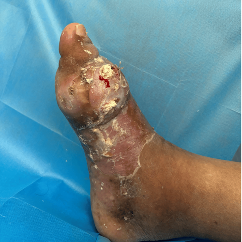 痛风开刀后伤口不愈合