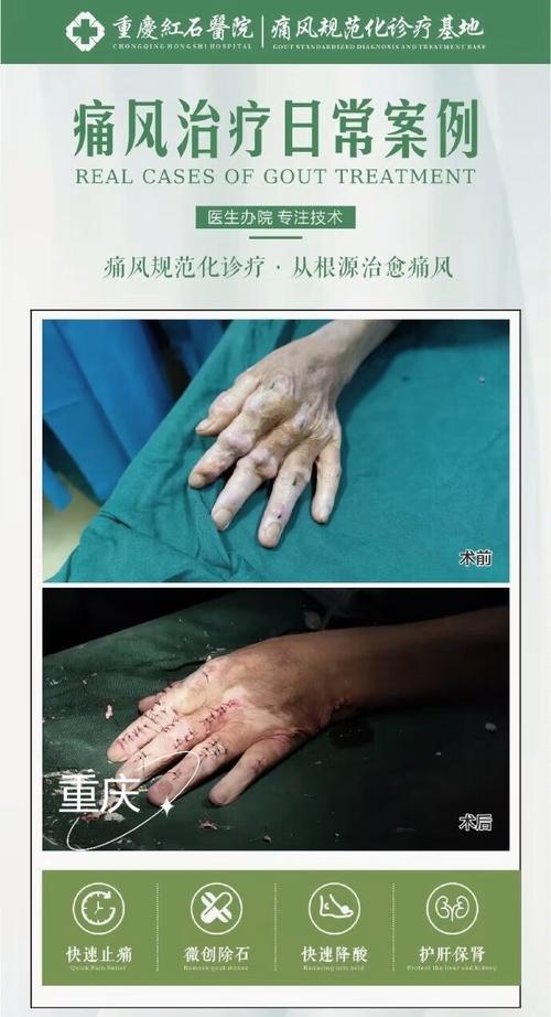 痛风石手术那家医院好
