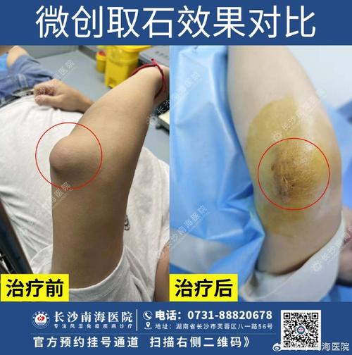 痛风石手术那家医院好