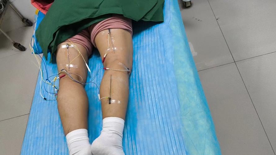 腰椎间盘突出针灸效果