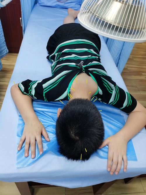 小儿抽动症可以针灸吗