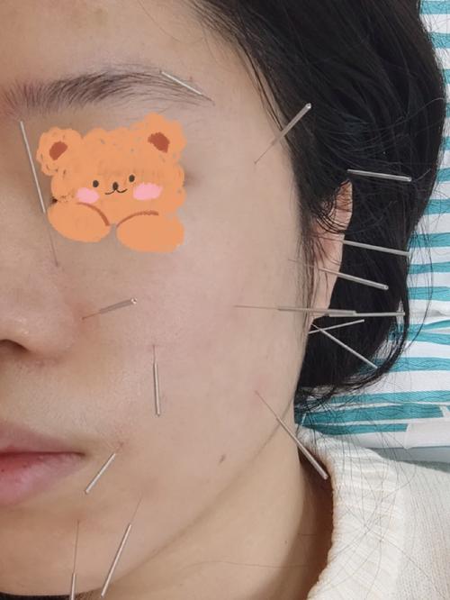 面部神经炎针灸40天