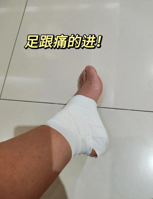 足跟骨刺针灸怎么治疗