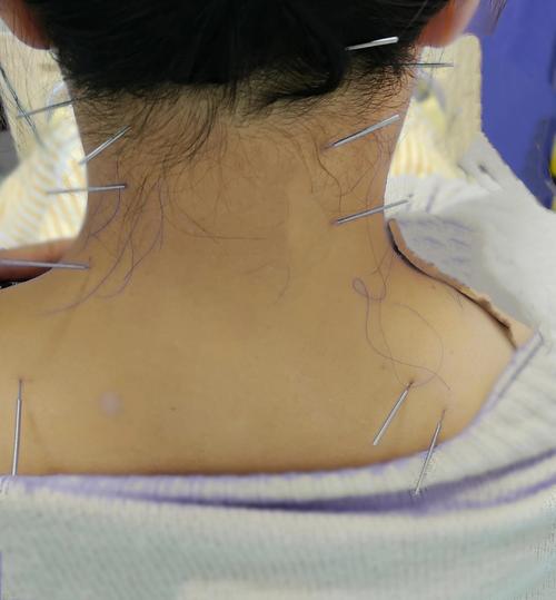 颈椎病针灸可以治好吗