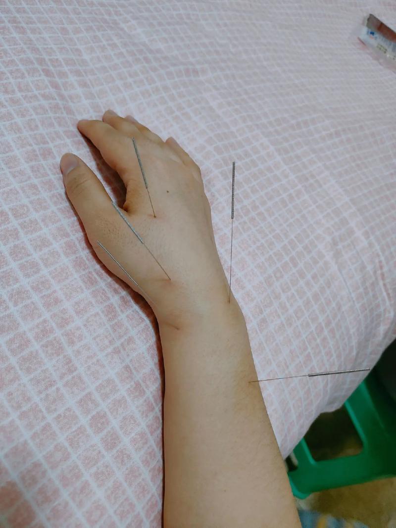 桡骨茎突腱鞘炎 针灸