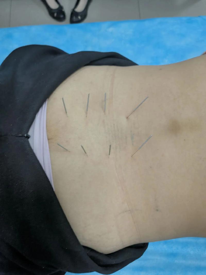 被病人用过的针灸针扎