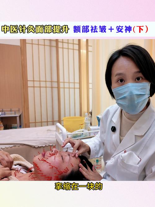 面部针灸后的注意事项