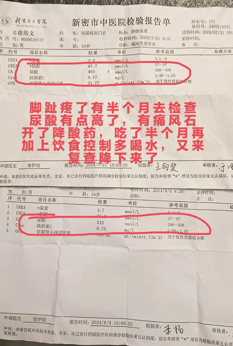 痛风犯了不排尿能好吗