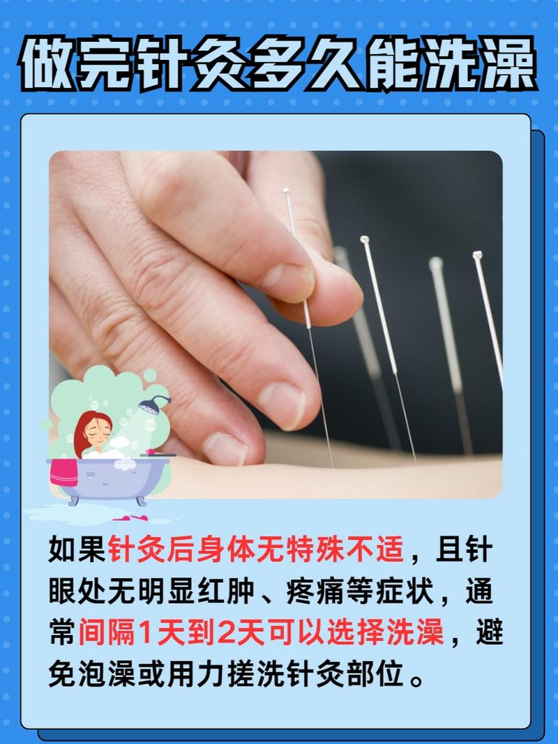 针灸完多久可以洗澡吗