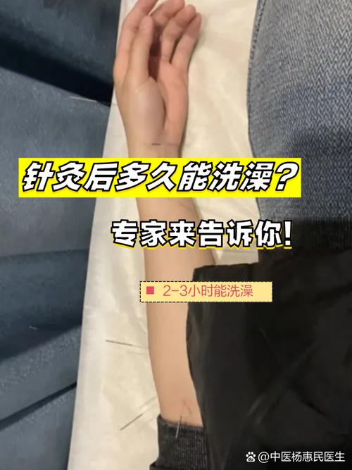 针灸完多久可以洗澡吗