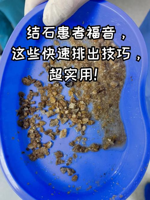 痛风石是如何排出体外
