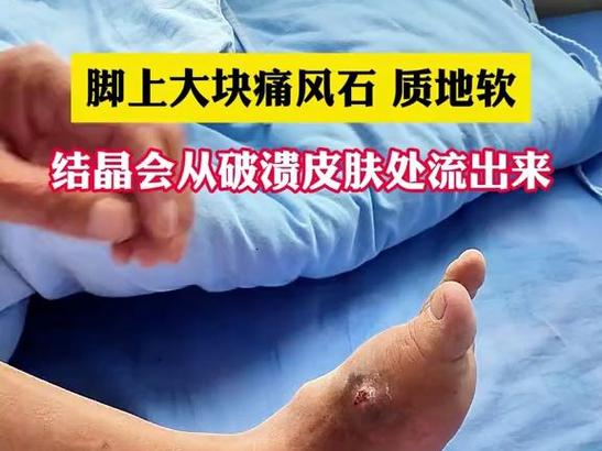 痛风石是如何排出体外