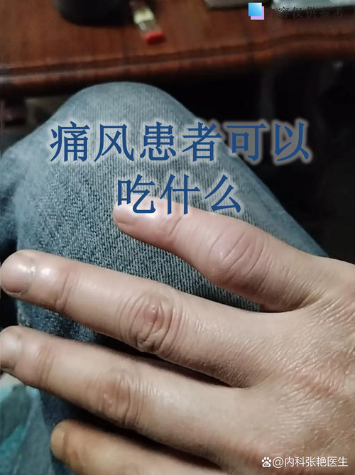 痛风可以吃可乐鸡翅吗