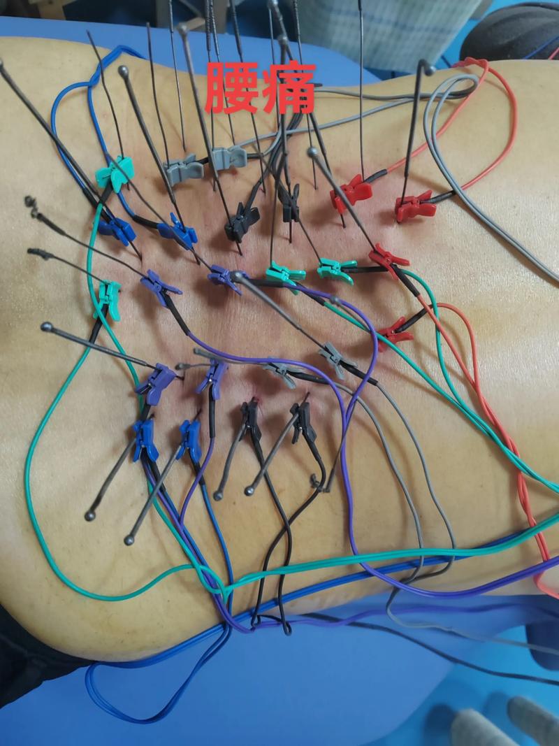 腰椎盘突出针灸有效吗