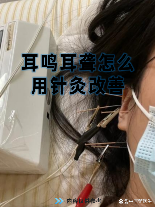 针灸治疗耳鸣有效果吗