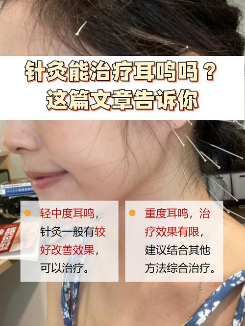 针灸治疗耳鸣有效果吗