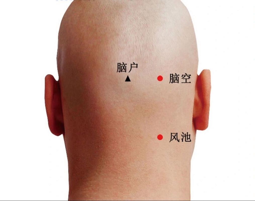 美尼尔综合症针灸治疗