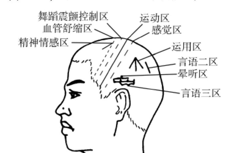 美尼尔综合症针灸治疗