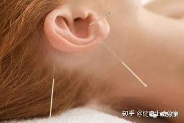 美尼尔综合症针灸治疗