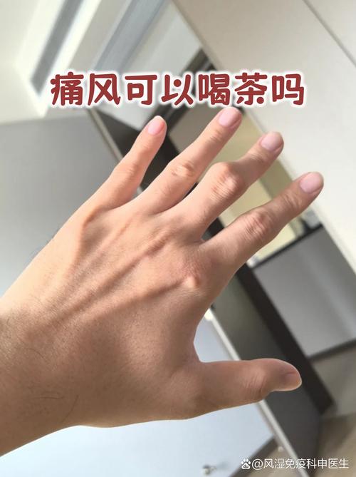 痛风患者应该喝什么茶