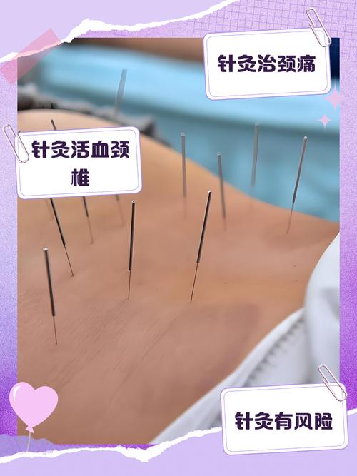 颈椎牵引好还是针灸好